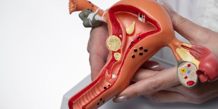 Aspirin intake can reduce women's risk of ovarian cancer - Study 92 Aspirin intake can reduce women’s risk of ovarian cancer – Study