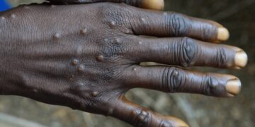 Rivers State confirms two cases of Mpox 1 Rivers State confirms two cases of Mpox