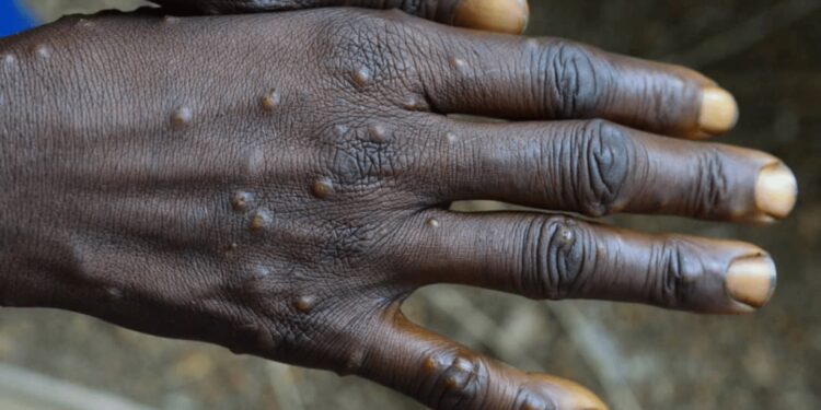 Rivers State confirms two cases of Mpox 92 Rivers State confirms two cases of Mpox