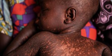 WHO: 10.3m infected with measles viral disease, 20% rise in 2023