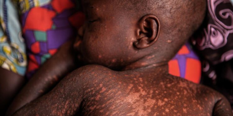 WHO: 10.3m infected with measles viral disease, 20% rise in 2023