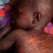WHO: 10.3m infected with measles viral disease, 20% rise in 2023 97 WHO: 10.3m infected with measles viral disease, 20% rise in 2023