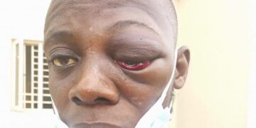 #JusticeForWasiuOduwole: Fresh reports emerge on graduate blinded by monarch 1 #JusticeForWasiuOduwole: Fresh reports emerge on graduate blinded by monarch