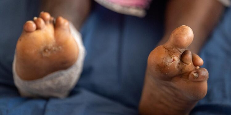 Drug delays stall leprosy patients' treatment for a year 92 Drug delays stall leprosy patients’ treatment for a year